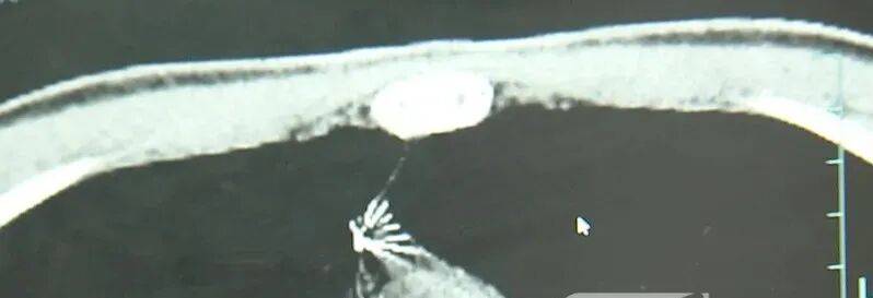 17岁小伙参军体检发现胸腔内有根5cm缝衣针<strong></p>
<p>比特儿海外版官网下载</strong>,父母回忆或是1岁时扎入,取出时已锈迹斑斑