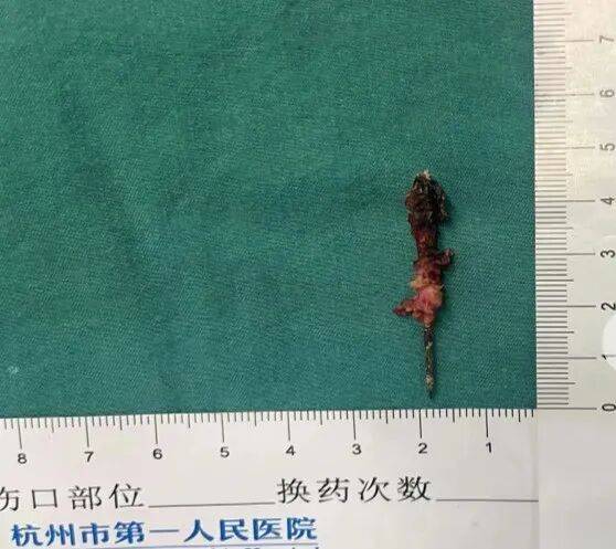 17岁小伙参军体检发现胸腔内有根5cm缝衣针<strong></p>
<p>比特儿海外版官网下载</strong>,父母回忆或是1岁时扎入,取出时已锈迹斑斑